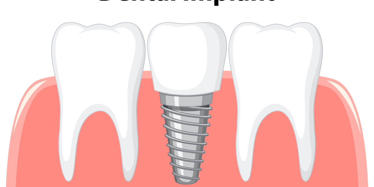 Get a Natural Smile Back with Expert Dental Implant Treatment