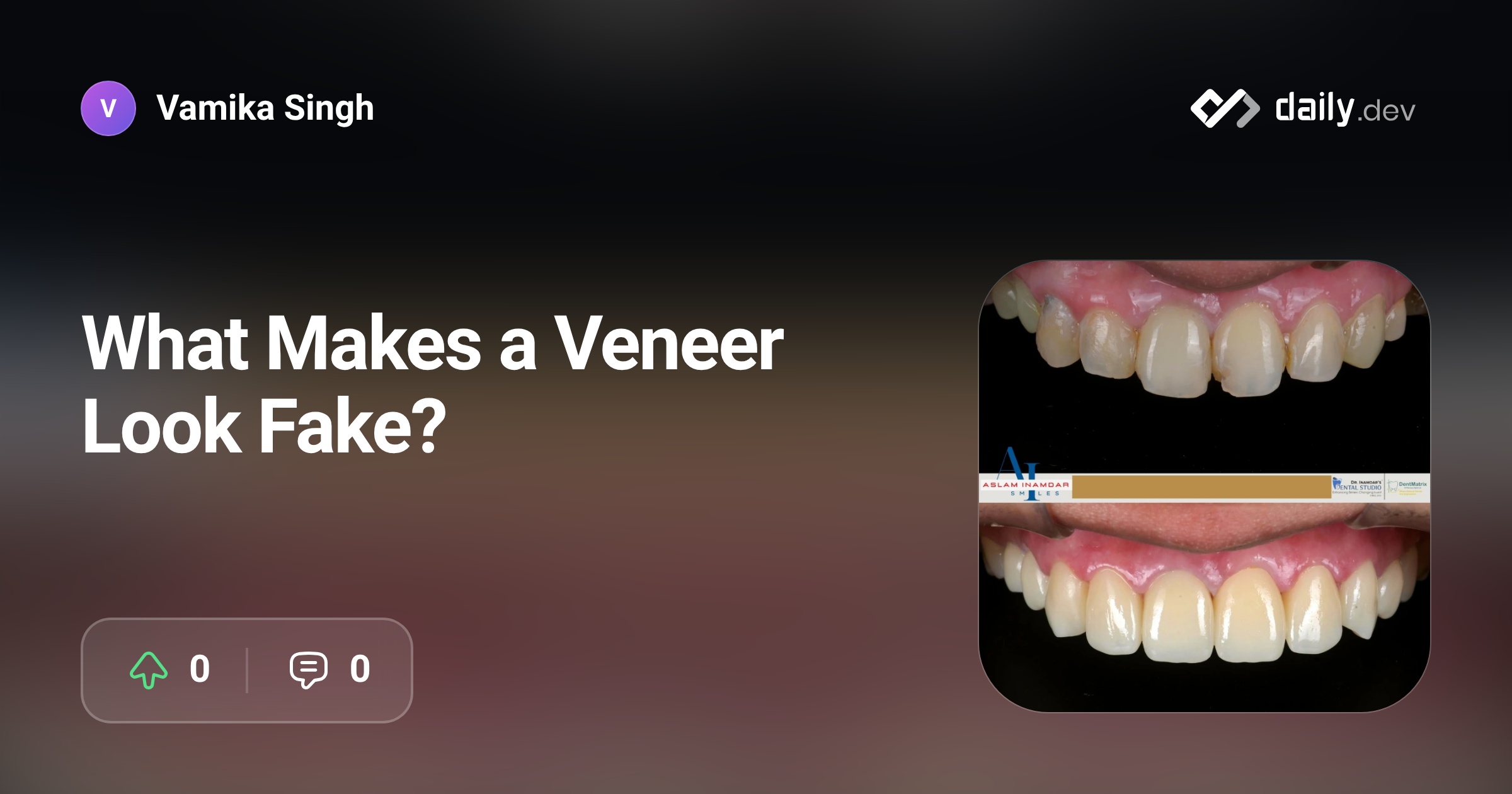 What Makes a Veneer Look Fake? | daily.dev