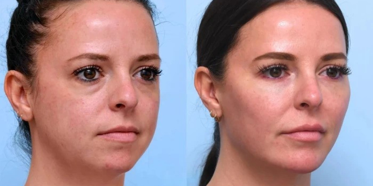 Best Doctors in Dubai Offering Modern PDO Thread Lift Solutions
