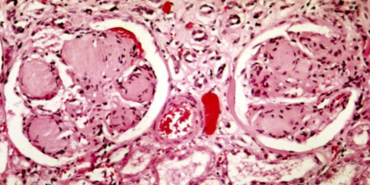 Understanding FSGS Types, Kidney Disorder, and Treatment Options