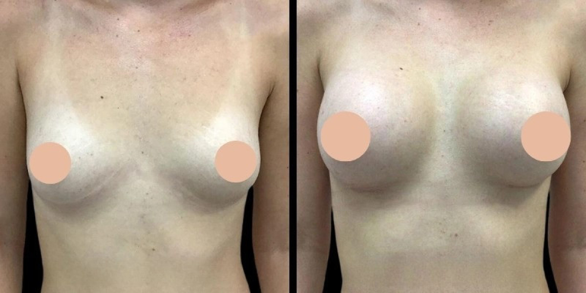 Best Doctors in Dubai for Breast Augmentation: Maintaining Results