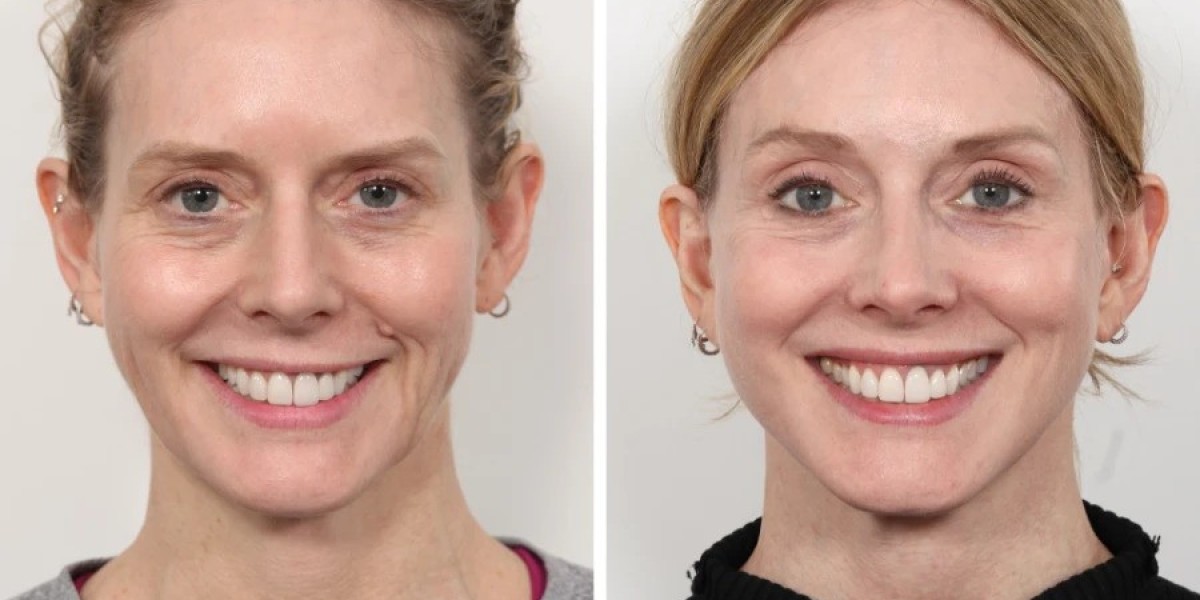 Best Doctors in Dubai for Non-Surgical Facial Thread Lift
