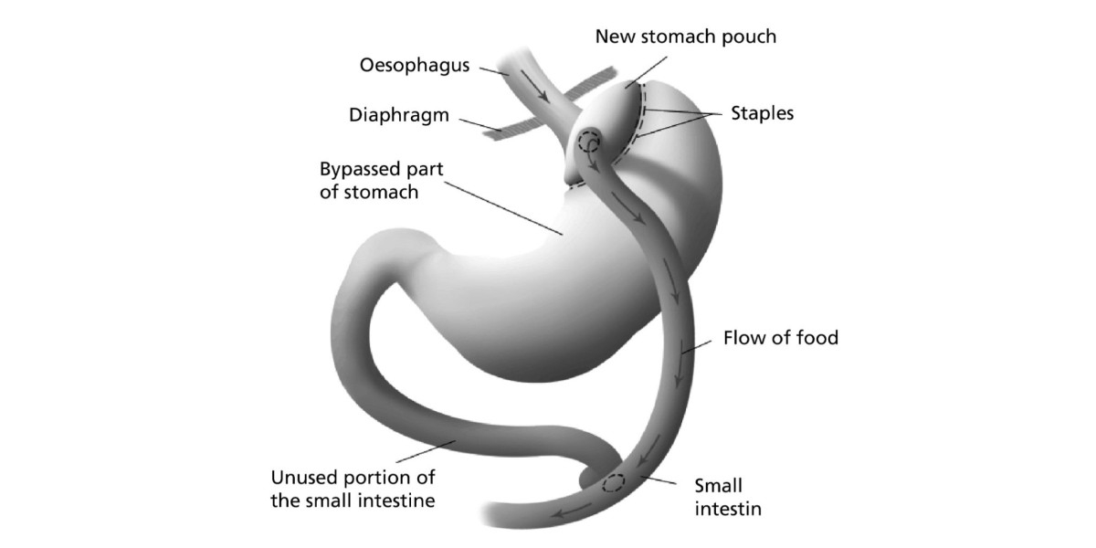 What Happens During Bariatric Surgery